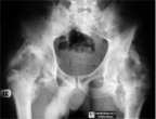Heterotopic Ossification